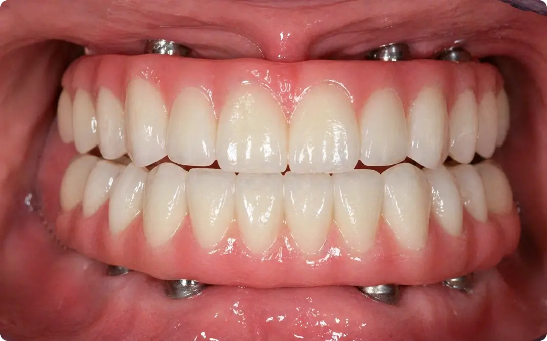 Implantes dentario