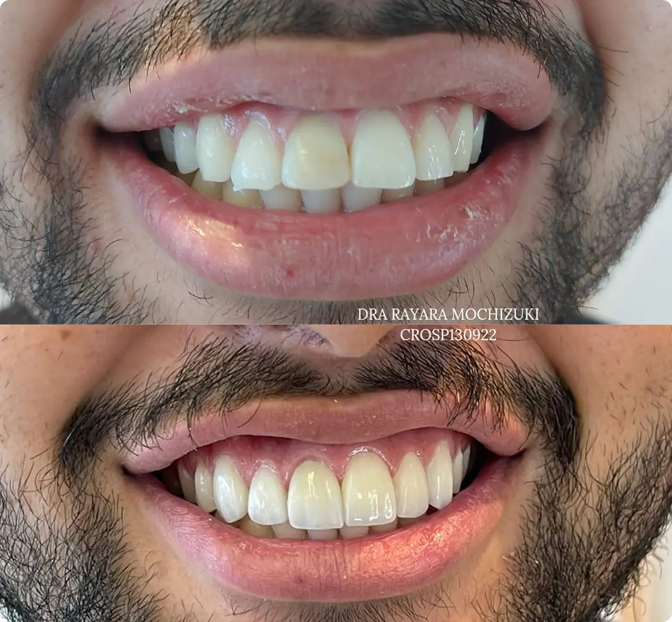 Facetas em Porcelana